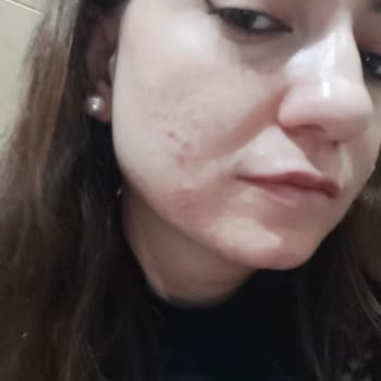 Yves Rocher Yanakta Çıkan Sivilce