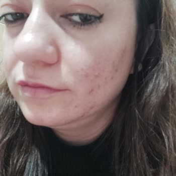 Yves Rocher Yanakta Çıkan Sivilce