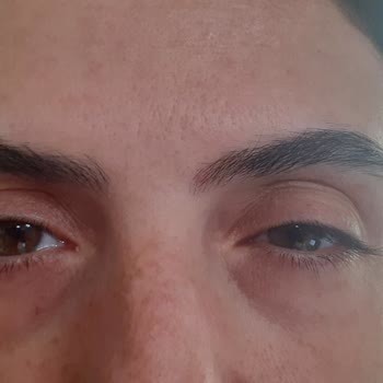 Ümran Tıp Merkezi Botokstan Görme Kaybı Yaşıyorum