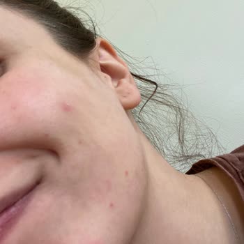 Missha Güneş Kremi Sivilce Yaptı