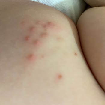 Sma Mama Uzun Süreli Alerji