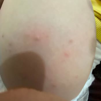 Sma Mama Uzun Süreli Alerji