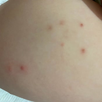 Sma Mama Uzun Süreli Alerji