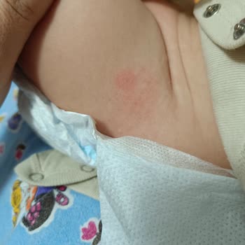 Molfix Bebeğimin Cildini Tahriş Etti
