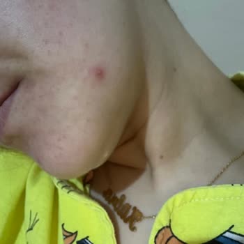 Neutrogena Sivilce Karşıtı Nemlendirici Yüzümü Yaktı