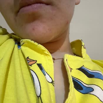 Neutrogena Sivilce Karşıtı Nemlendirici Yüzümü Yaktı