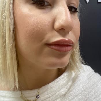 Dr. Funda Garip Uçar Hatalı Dudak Dolgusu İşlemi!