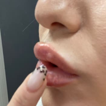 Dr. Funda Garip Uçar Hatalı Dudak Dolgusu İşlemi!