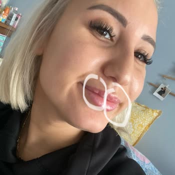 Dr. Funda Garip Uçar Hatalı Dudak Dolgusu İşlemi!