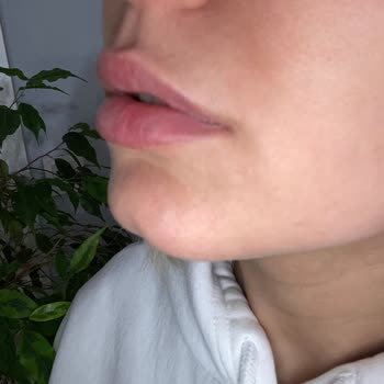 Dr. Funda Garip Uçar Hatalı Dudak Dolgusu İşlemi!