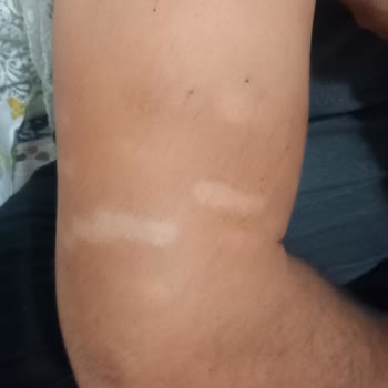 Lavinya Golden Antalya Azalmayan Vücut Kılı Ve Kol Yanığı