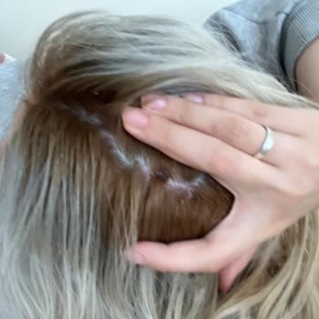 Palette Saç Derimi Yaktı