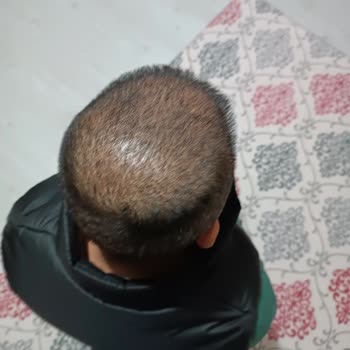 Estecenter Saç Ekimi İlgisizliği