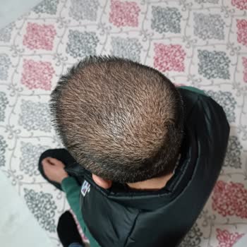 Estecenter Saç Ekimi İlgisizliği