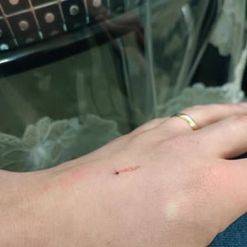 Hatem Hastanesi Damar Yolu Açamıyor