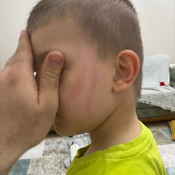Eyüp Sabri Tuncer Gül Kolonya Alerjen Etki Var Cildimiz Kızardı