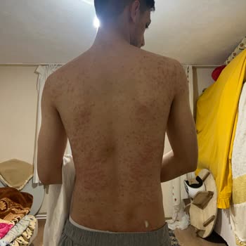 Veet Kremi Sivilce Yara Yaptı