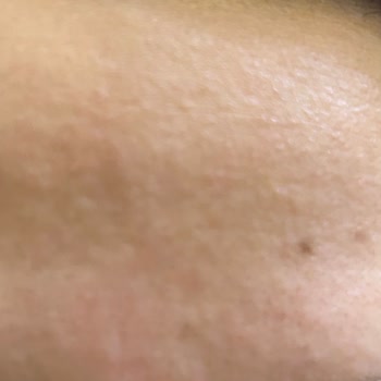 La Roche Cildi Mahvediyor Mahvoldu Cildim