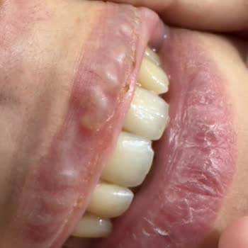 Medicine Hospital Hastane Dermatoloji Bölümünde Yaşanan Sorunlu Estetik İşlem