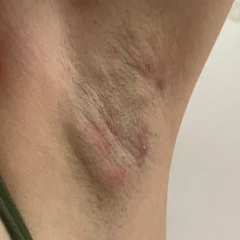 Bella World Enfeksiyon Kaptım Lazerden