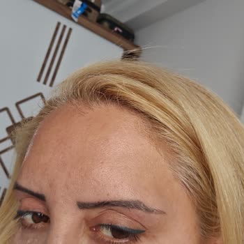 Sym Estetik Göz Kapağı Felaket Sonuç