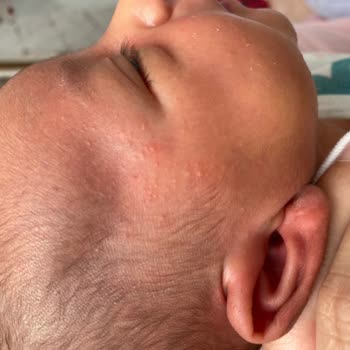 Sma Optipro Alerji Yaptı