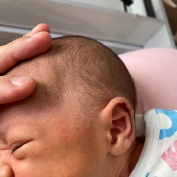 Sma Optipro Alerji Yaptı