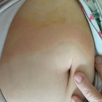 Dr. Pedical (drpedical) Alerji Yapan Hasta Bezi