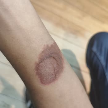 Nivea Deodorant Sonrası Ciltte Yanma Ve Leke Sorunu