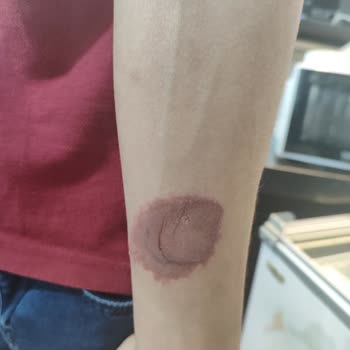 Nivea Deodorant Sonrası Ciltte Yanma Ve Leke Sorunu