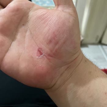 BinBin Aracının Gidonu Kırıldı Ve Yaralandım