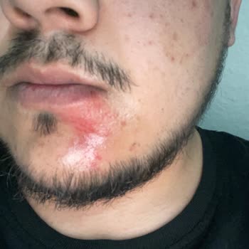 BinBin Aracının Gidonu Kırıldı Ve Yaralandım