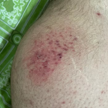 BinBin Aracının Gidonu Kırıldı Ve Yaralandım