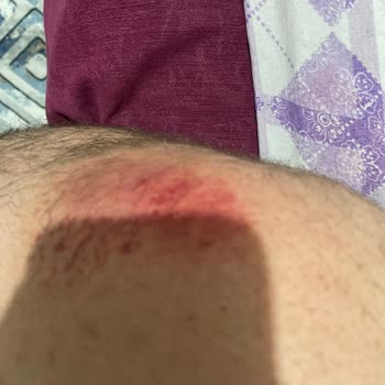 BinBin Aracının Gidonu Kırıldı Ve Yaralandım