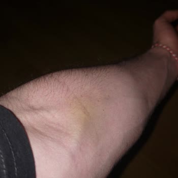 Pendik Devlet Hastanesi Kan Alma Bölümündeki Hemşireler Çok İlgisiz.