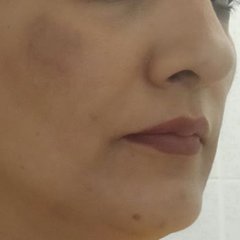 Awera Güzellik ve Estetik Awera Guzellik& Estetikten Para İadesi Ve Tedavi Masrafları İstiyorum