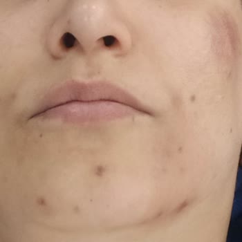 Awera Güzellik ve Estetik Awera Guzellik& Estetikten Para İadesi Ve Tedavi Masrafları İstiyorum