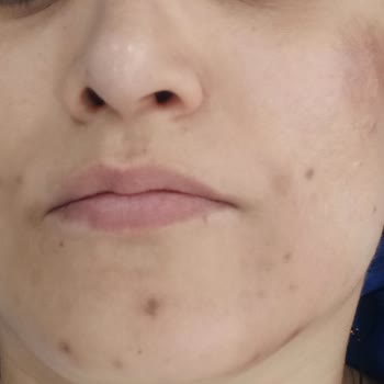 Awera Güzellik ve Estetik Awera Guzellik& Estetikten Para İadesi Ve Tedavi Masrafları İstiyorum