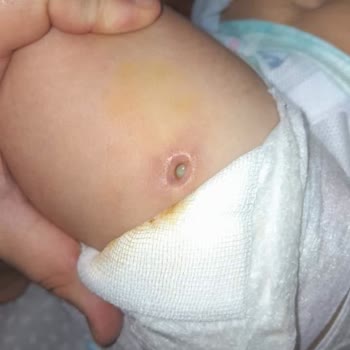 Özel Aritmi Osmangazi Hastanesi Enjeksiyon Hatası Sonucu Bakteri Üremesi Doku Kaybı