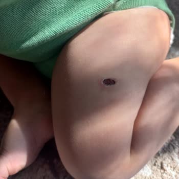 Özel Aritmi Osmangazi Hastanesi Enjeksiyon Hatası Sonucu Bakteri Üremesi Doku Kaybı