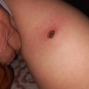 Özel Aritmi Osmangazi Hastanesi Enjeksiyon Hatası Sonucu Bakteri Üremesi Doku Kaybı