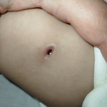 Özel Aritmi Osmangazi Hastanesi Enjeksiyon Hatası Sonucu Bakteri Üremesi Doku Kaybı