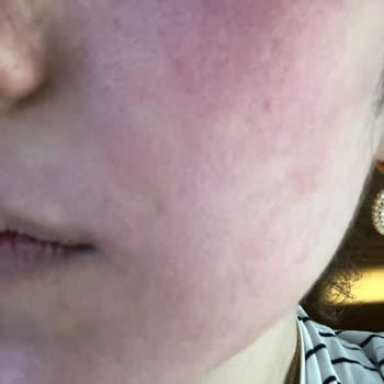 Dermokil Maske Yüzümü Resmen Mahvetti!