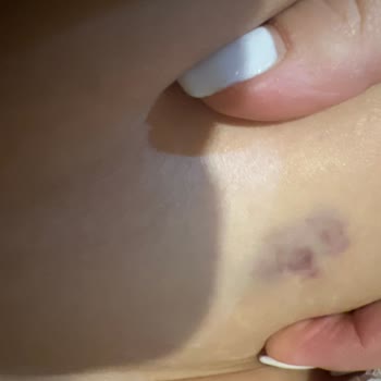 Saxenda İğne İşe Yaramadı