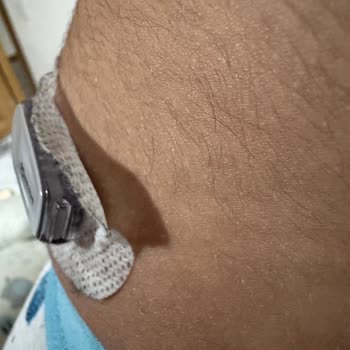 Medsalus Dexcom G6 Sensör Bantları Tutmaz Oldu