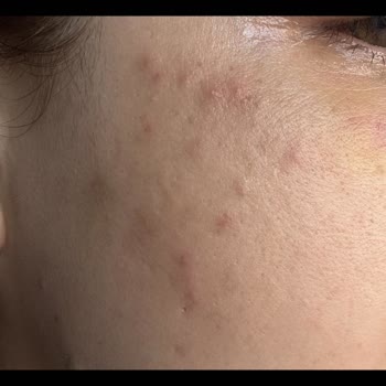 Aris Güzellik Merkezleri Kayseri'de Yaşanan Lazer İşlemi Ve Cilt Bakımı Şikayeti