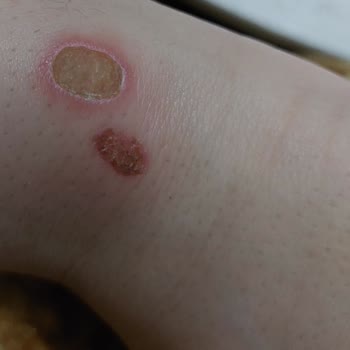 Belavil Güzellik Merkezi Belavil De Yanık