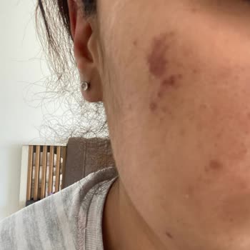 Sesu Markası Çok Kötü Kahverengi Leke