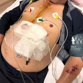 Sanko Üniversitesi Hastanesi Sanko Hastanesinde Kaybettiğim Acı Kaybım Hakkında Şikayetim