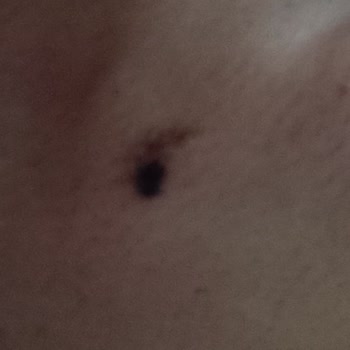 Cleopatra Güzellik Merkezi Epilasyon İşleminde Cilt Yanığına Maruz Kaldım!